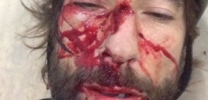 brumotti incidente viso deturpato
