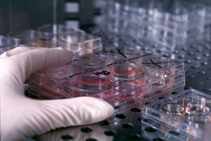 Sclerosi multipla, test con cellule staminali per fermare i sintomi